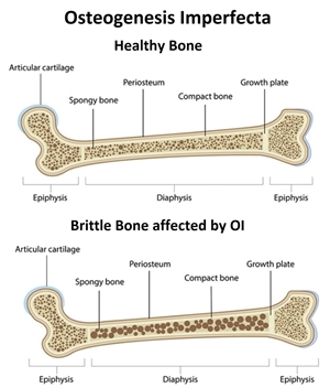 Comparing healthy bone structure with bone affected by Osteogenesis Imperfecta