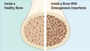 Osteogenesis Imperfecta OI