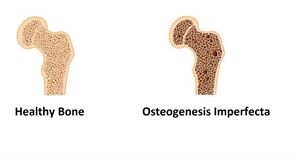 OI - Osteogenesis Imperfecta