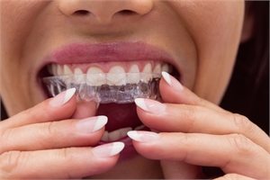 How to Keep Your Aligners Pearly White with Invisalign Cleaning Crystals