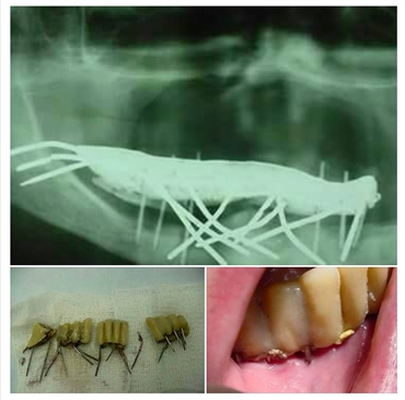Shocking Dental Implants