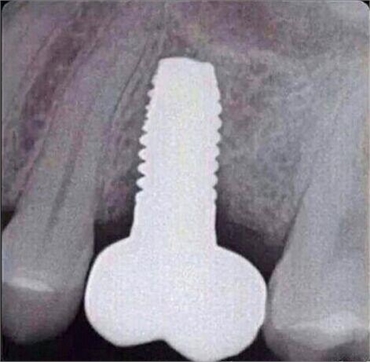 What is this type of dental implant
