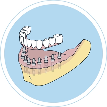 full-mouth-dental-implant-graphic