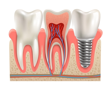 The Art and Science of Root Canal Therapy