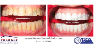 Composite veneers is one of the options to get the perfect smile only in one session without drillin