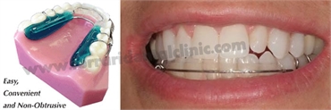 A Fantastic Simple Fast and Hassle-free way of straightening your front teeth Only at Ferrari dental