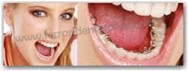 Lingual braces are custom made fixed braces bonded to the back of the teeth making them invisible to