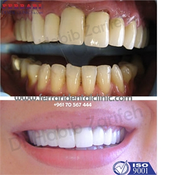 Cad Cam full veneers  no impressions no pain only at Ferrari Dental Clinic with Dr.Habib Zarifeh