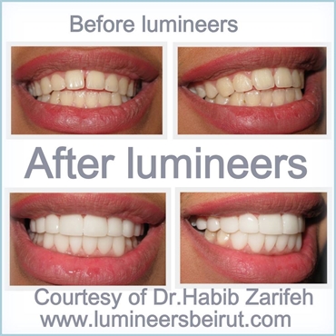 Dr Habib Zarifeh the certified Lumineers dentist in Lebanon and the middle east Hollywood Smile only