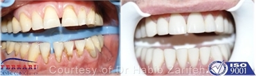 At Ferrari dental clinic we offer you your celebrity smile with full ceramic Zirconium veneers in a 