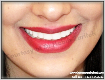 Teeth whitening has many options  laser smile or permanent teeth whitening using Lumineers by Cerina