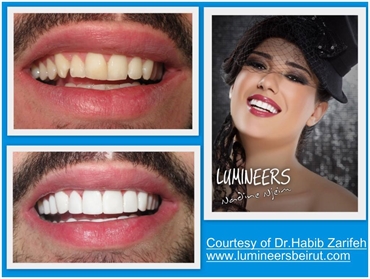 At Ferrari dental clinics and labs our laser technology lumineers placement is considered to be the 