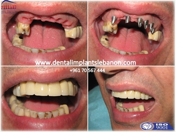 Dr.Habib is your best choice to treat your missing teeth . Dental implants aren't anymore a complica
