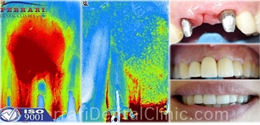 At Ferrari Dental Clinic we targeted on autograft xenograft and especially Easy Graft cristal synthe