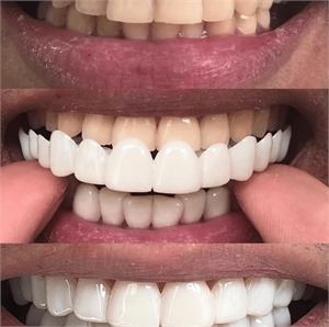 Snap on smile is a reserved brand of removable teeth which improve the appearance of your smile