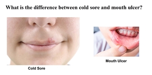 What is the difference between cold sores and mouth ulcers?