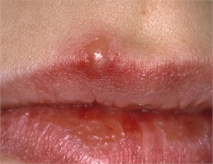 Cold sores are caused by Herpes Simplex Virus (HSV). Cold sores are filled with fluids which develop as blisters