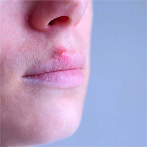 Cold sore is a viral infection which appears as a cluster of small blisters around the mouth and the chin. Cold sores are always extraoral - not on the inside of the cheeks and lips