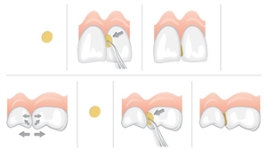 Phocal fluoride disks are placed in the interproximal dental space
