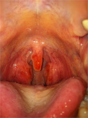 Swollen uvula. Possible reasons for inflammation causing enlarged uvula are infections, allergies, trauma and dehydration.