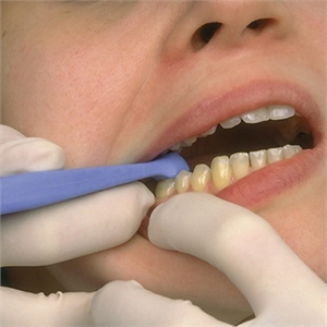 Fracfinder is also known as Tooth Slooth and tooth sleuth. It detects fractures in vital teeth.