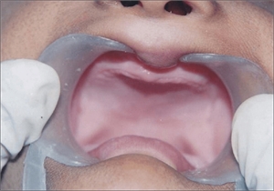 Dental anodontia - having no teeth