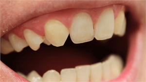 Hypodontia - missing lateral incisors with a closed space.