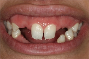 Oligodontia is a dental condition of having less teeth (more than 6)
