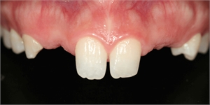 Oligodontia in dentistry