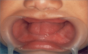 Anodontia means having no permanent or no deciduous (baby) teeth.