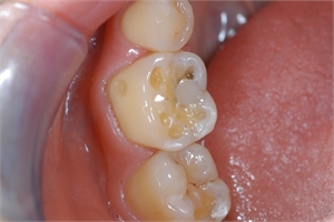 Tooth cupping is occlusal wear forming small cups in the chewing surface of the teeth