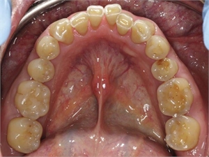 Overall occlusal wear, called teeth cupping