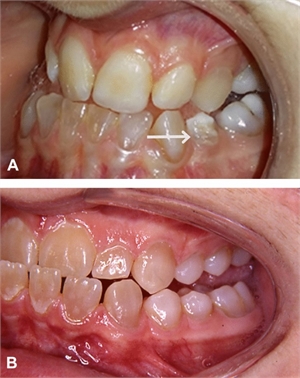 Dentinogenesis imperfecta is a genetic dental condition which causes damage to the dentin structure of the teeth