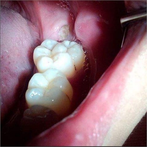 Teeth gemination in molars