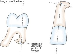 Tooth dilaceration