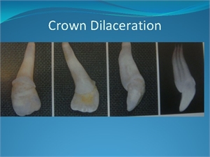 Tooth crown dilaceration