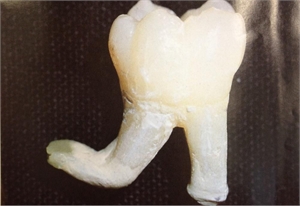 Dental root dilaceration