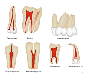Difference between dilaceration, gemination, concrescence, tooth fusion, taurodontism, dens evaginatus and dens invaginatus