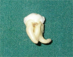 Dilaceration on tooth