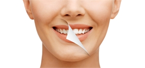 Teeth Whitening Treatment in Ladner