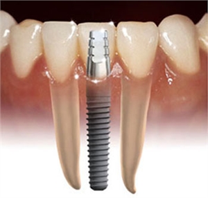 Top 7 Reasons Dental Implants Are Important