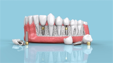 What Happens If A Dental Implant Breaks