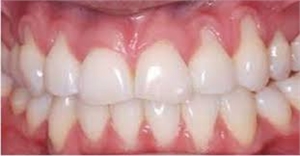 Gum disease Receding Gums treatment