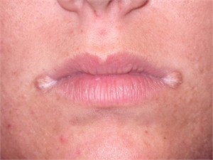 Angular cheilitis is skin inflammation around the corners of the mouth
