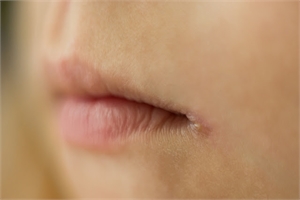 Angular cheilitis around the corner of the lips