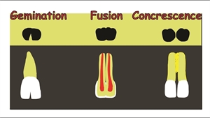 What is the difference between teeth gemination, fusion and concrescence