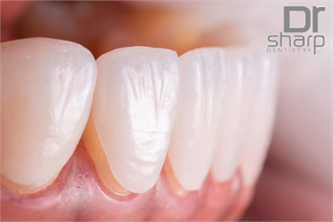 Six Amazing Benefits Of Porcelain Veneers For Transforming Your Smile