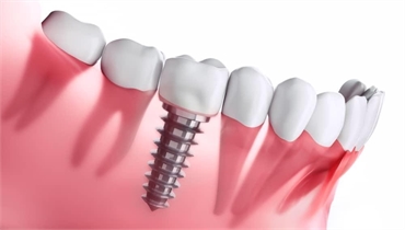 Stages of Healing After Dental Implant Surgery