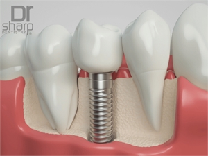 Dental implants in Miami