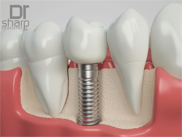 5 Facts You Should Be Aware Of Dental Implants